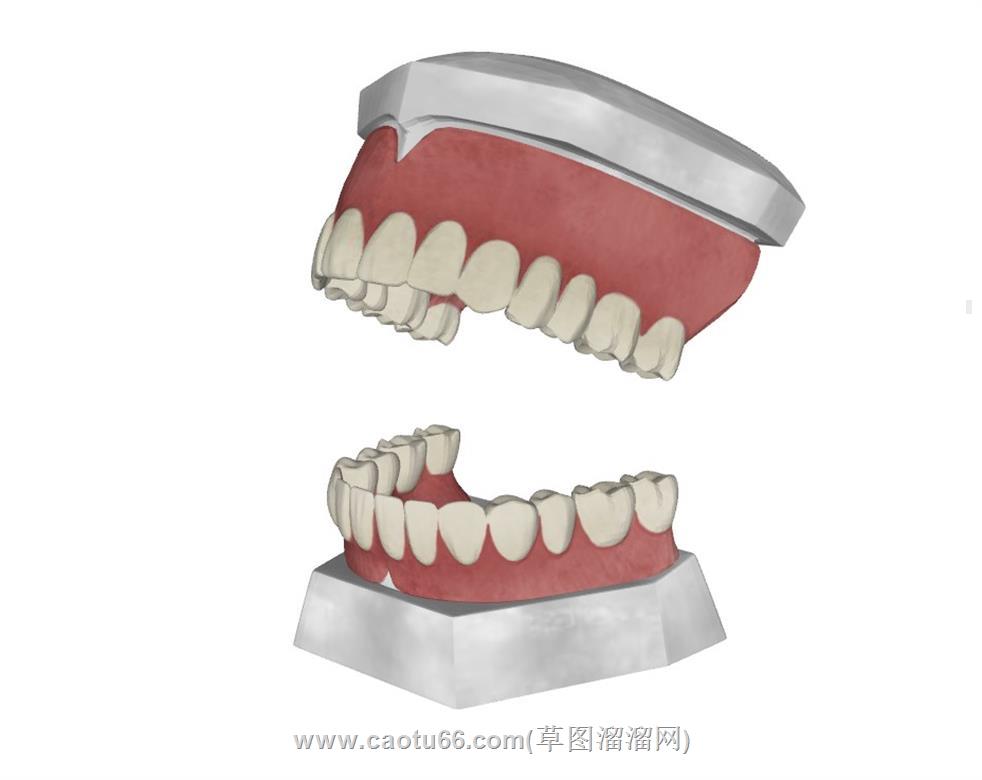 牙科口腔假牙SU模型 1